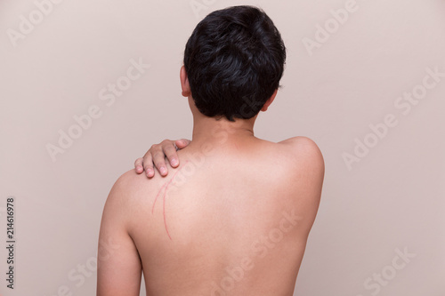 scar on man back fresh injury
