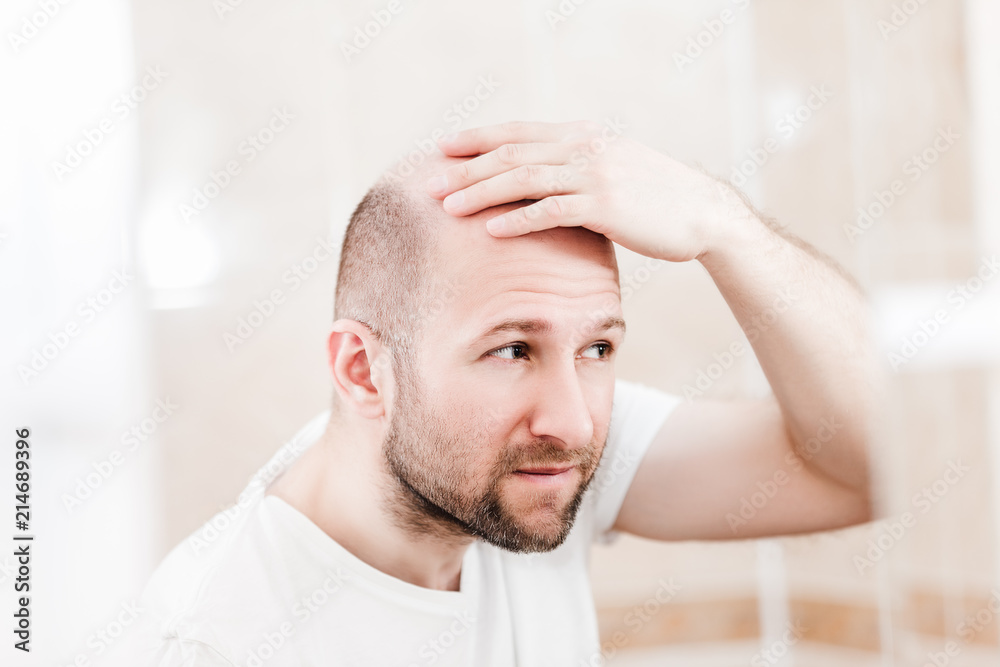 Bald man looking mirror at head baldness and hair loss Bald man looking mirror at head baldness and hair loss