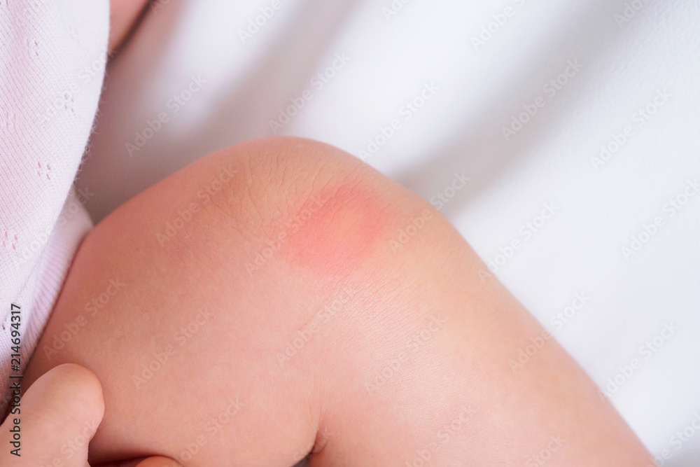 Baby Skin Rash And Allergy With Red Spot Cause By Mosquito Bite At Knee Stock Photo Adobe Stock