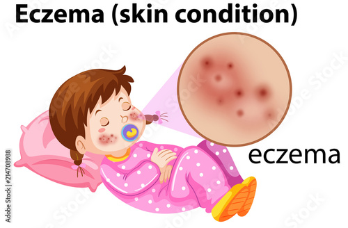 Magnfied eczema on young girl