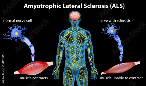 Anatomy of amyotrophic lateral sclerosis photo