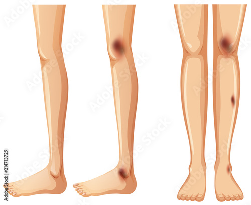 Side and front of bruises on leg