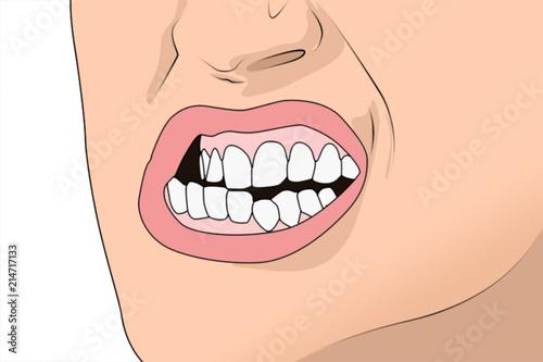 Bruxism Teeth Grinding
