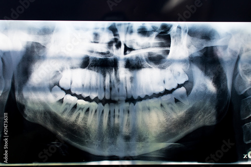 X-ray of a mouth with all visible teeth and cavity in evidence. Orthopanoramic radiographt at the dentist with caries and fillings showned by the doctor. teeth image.