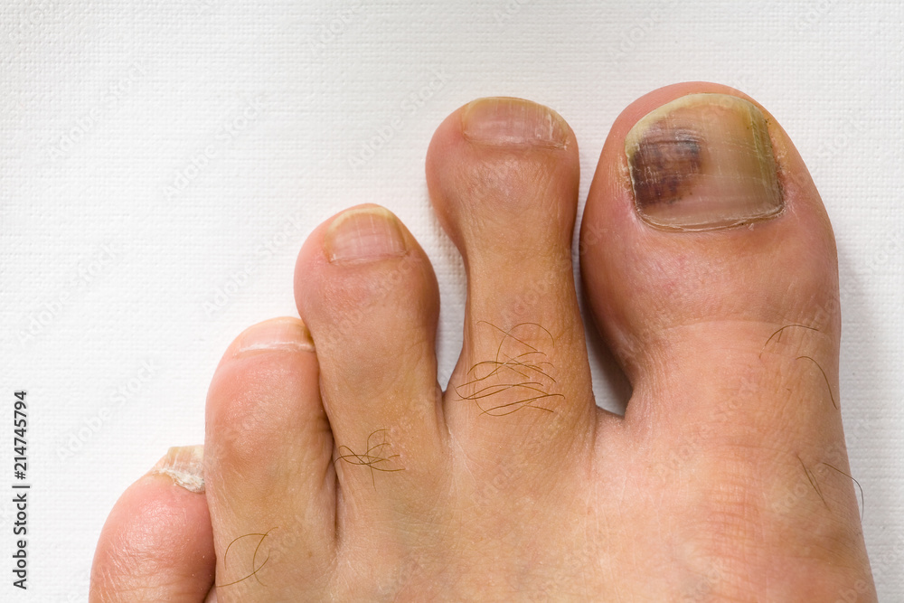 The bruised finger of the male foot close-up.