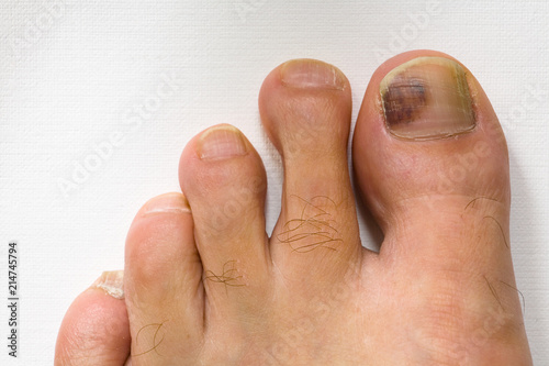 Obraz na płótnie The bruised finger of the male foot close-up. w salonie