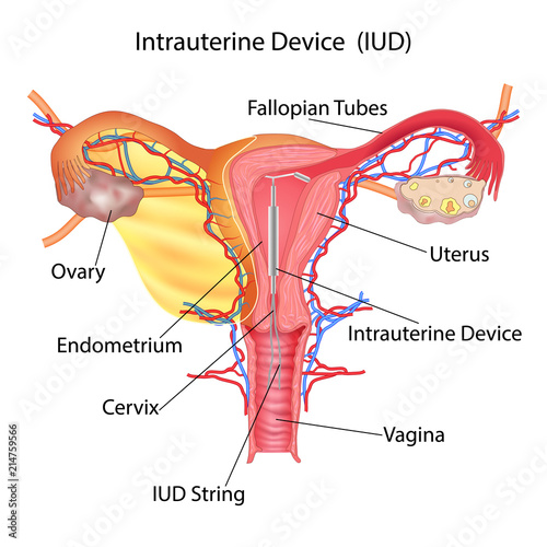 intrauterine device from pregnancy