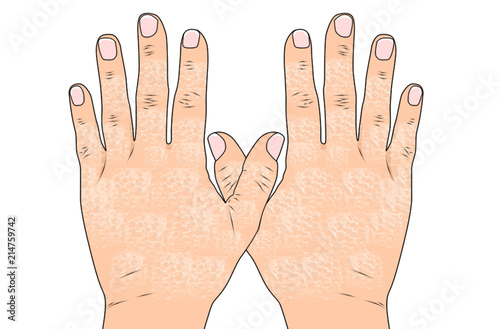 Dry Chapped Hands