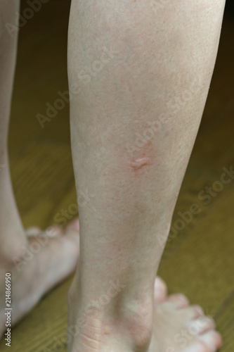 蚊に刺された足 © kelly marken