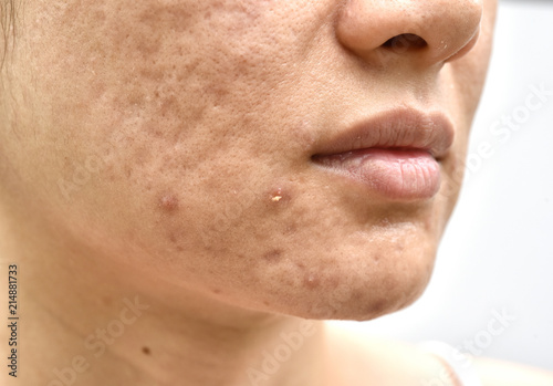 Obraz na płótnie Skin problem with acne diseases, Close up woman face with whitehead pimples, Menstruation breakout, Scar and oily greasy face, Beauty concept. w salonie
