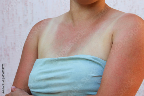 Woman was burned in sun. Sunburn.