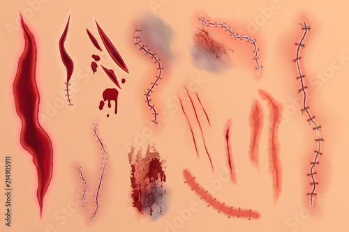 Fotografia Realistic vector various bloody wounds, surgical stitches, scars, bruise and slaughter set on the skin background
