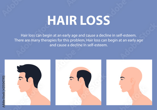 Stages of male pattern baldness. Hair loss. Alopecia. Asian men. Vector Flat Illustration