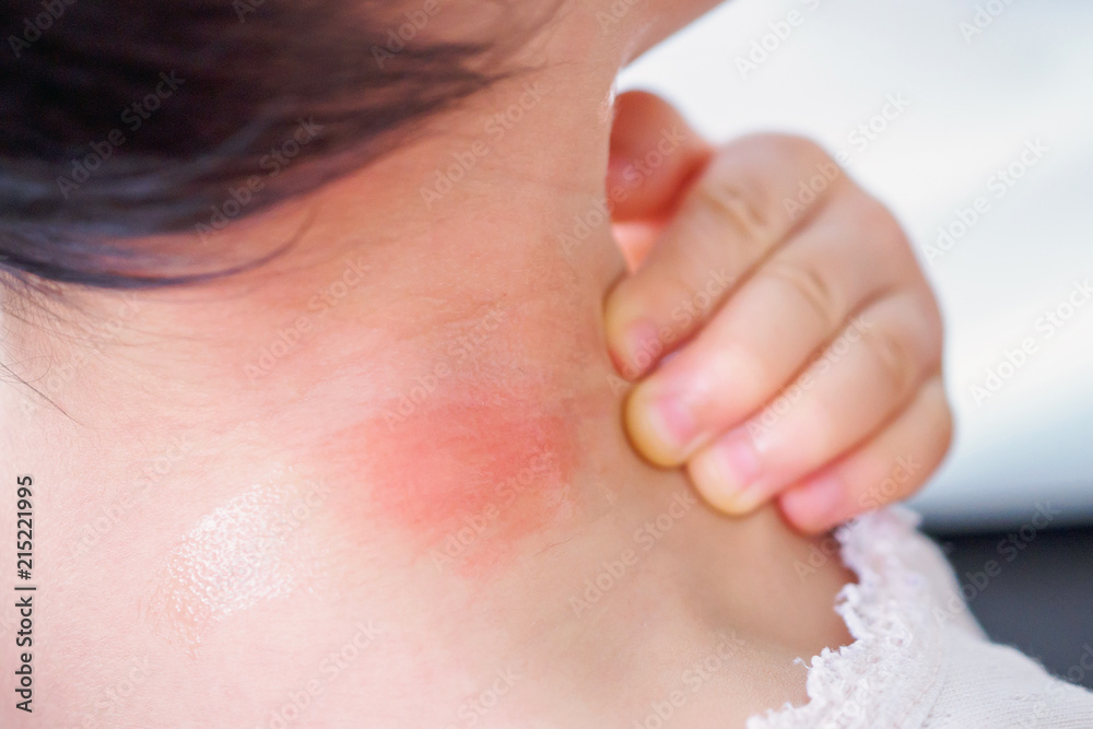 Baby Skin Rash And Allergy With Red Spot Cause By Mosquito Bite At Neck Stock Photo Adobe Stock