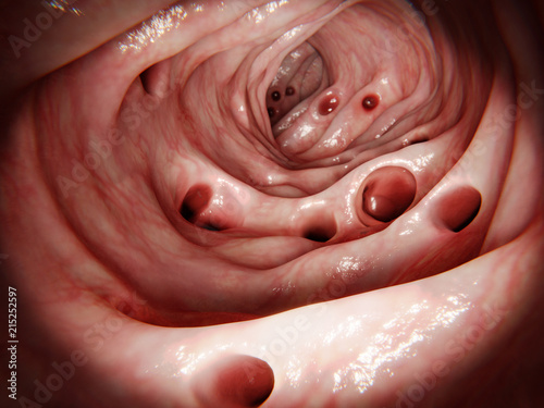 Massive diverticulosis in human intestine photo
