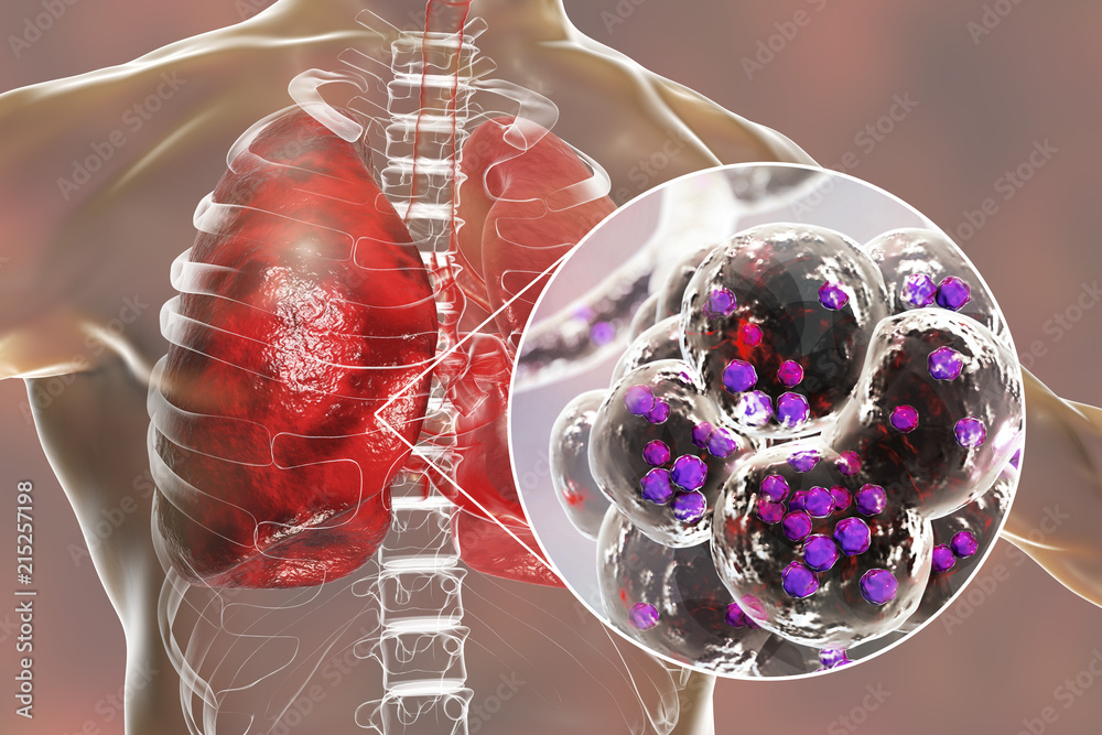 Staphylococcal pneumonia, medical concept. 3D illustration showing bacteria Staphylococcus