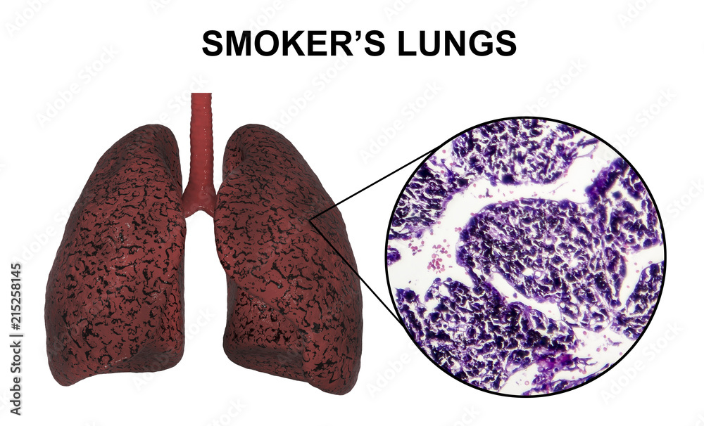 Smoker's lungs, 3D illustration and light micrograph, photo under