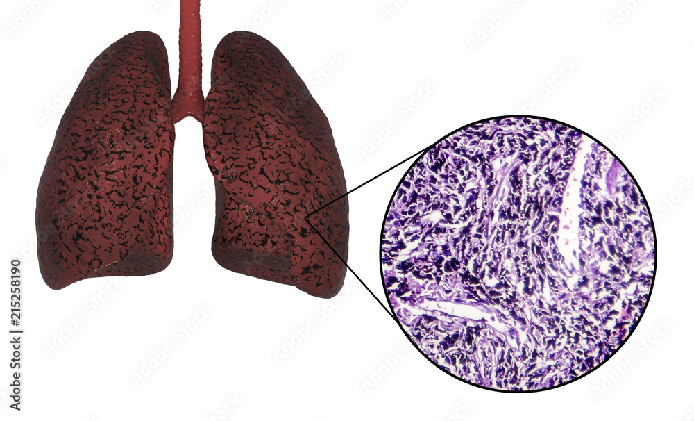 Smoker's lungs, 3D illustration and light micrograph, photo under miscroscope showing