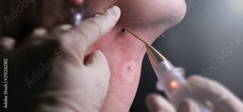 cosmetic procedure  removal of a birthmark or papilloma with a laser.