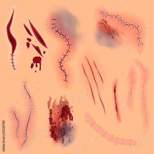 Surgical vector stitches, scars, bruise and slaughters set on the skin.