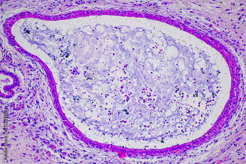 micrograph of human nasal polyp photo