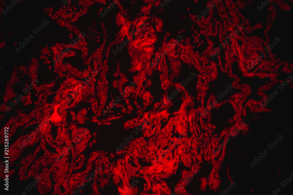 chronic obstruction of human lung chronic obstruction of human lung