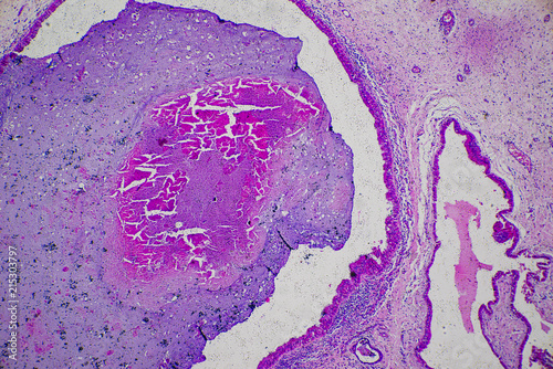 micrograph of human nasal polyp