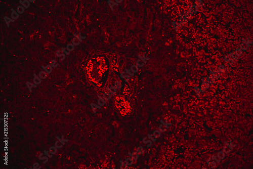 chronic obstruction of human liver