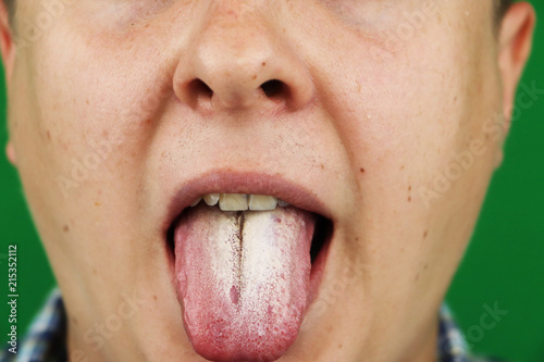 Man with halitosis for Candida albicans on tongue