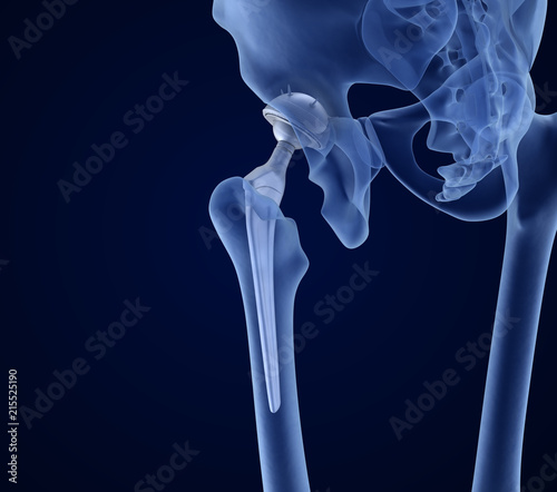 Hip replacement implant installed in the pelvis bone. X-ray view. Medically accurate 3D illustration photo