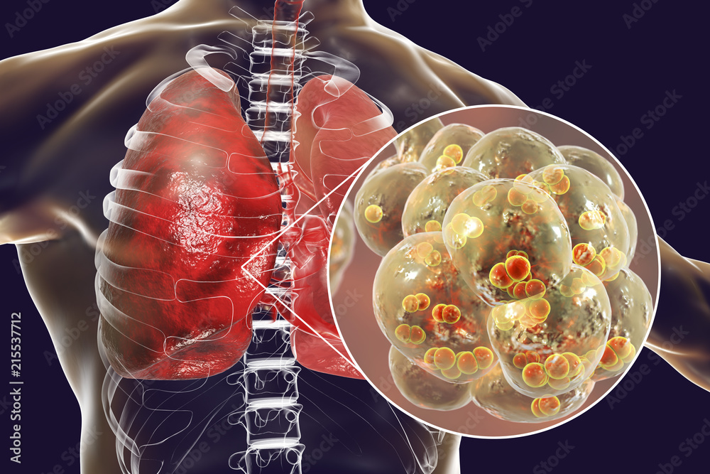 pneumococcal-pneumonia-medical-concept-3d-illustration-showing