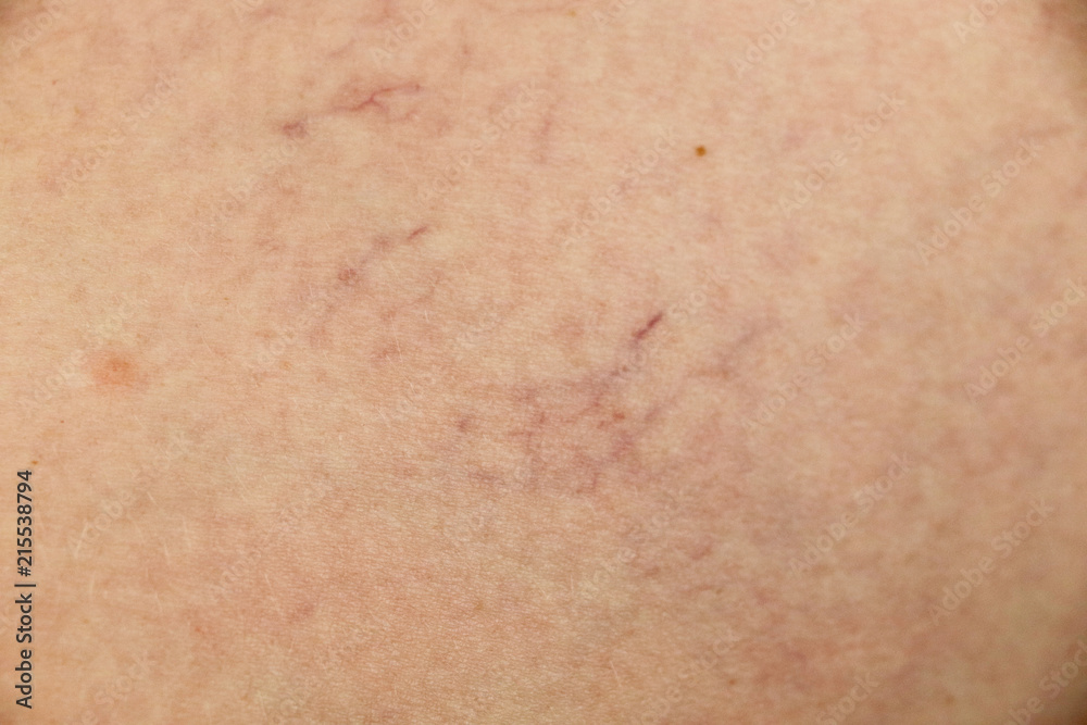 Varicose veins and capillary veins in the legs. Medical inspection and treatment
