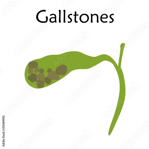 Gallbladder disease, inflammation. Gallstones. Cholecystitis. Anatomy vector flat illustration. White background.