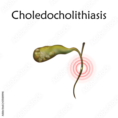 Gallbladder disease, inflammation, gallstone blocks common bile duct. Choledocholithiasis. Anatomy vector realistic illustration. White background.