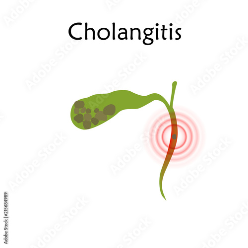 Gallbladder disease, inflammation, gallstone blocks common bile duct. Cholangitis. Anatomy vector flat illustration. White background.