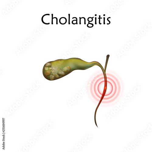 Gallbladder disease, inflammation, gallstone blocks common bile duct. Cholangitis. Anatomy vector realistic illustration. White background.