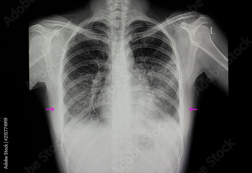 a patient with both lungs pneumonia