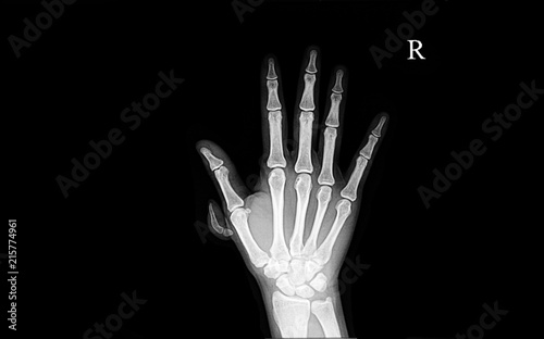 polydactyly