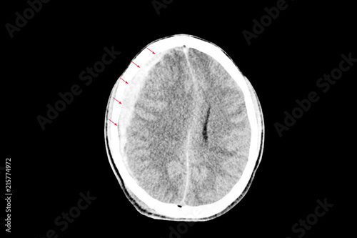 subdural hemorrhage with brain edema