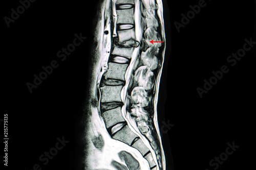 MRI scan of lumbar spines of a patient with kyphosis and back pain showing herniated disc from spondylodiscitis most likely from an infection such as staphylococci or mycobacteria.