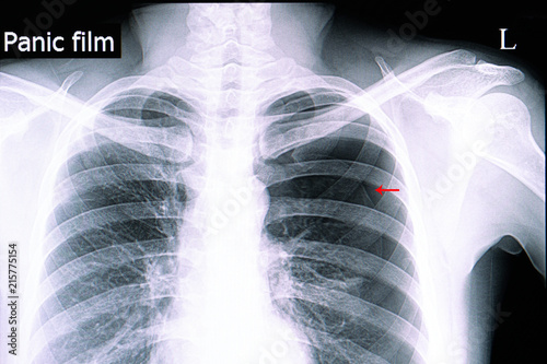 spontaneous pneumothorax photo