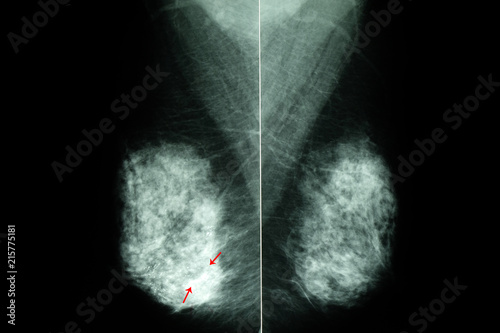 mammogram of  female breasts