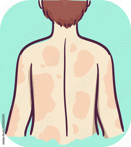 Symptoms Back Hives Illustr...
