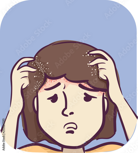 Symptoms Girl Head Dandruff...