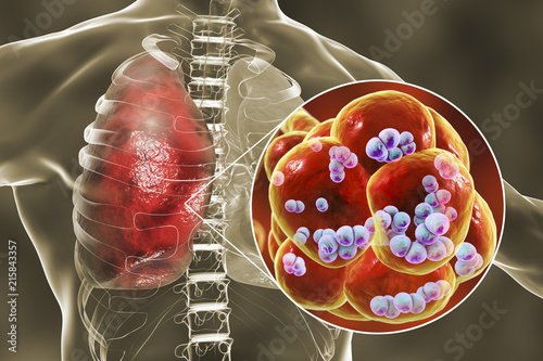 Pneumococcal pneumonia, medical concept. 3D illustration showing bacteria Streptococcus pneumoniae inside alveoli of the lung photo