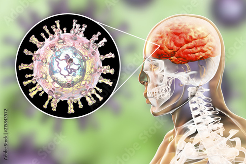 Varicella zoster virus VZV encephalitis, medical concept, 3D illustration showing brain infection and close-up view of VZV in the brain. Encephalitis is one of complications of chickenpox photo