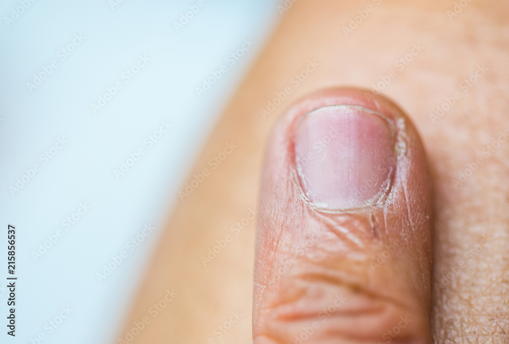 Finger nail have fungus Finger nail have fungus
