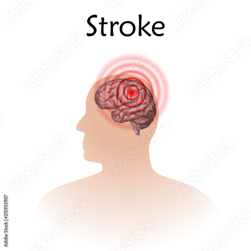 Stoke poster, banner. Vector medical illustration. White background, pink silhouette of man head, anatomy image of damaged human brain.