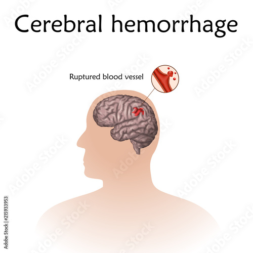 Cerebral hemorrhage poster, banner. Vector medical illustration. white background, anatomy image of damaged human brain, ruptured blood vessel, male silhouette.