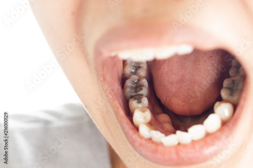 Dental fillings and dental caries.